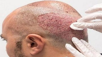 كيفية اختيار أفضل دكتور لزراعة الشعر في مصر