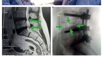 فريق جراحى بكفر شكر التخصصى ينقذ مريضة من الإصابة بالشلل بعد تركيب قفص كربوني